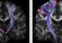 Dos sobreviviente di infarto ta move nan man atrobe despues di terapia experimental