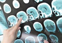 AI desaroya na Hulanda ta miho den diagnostica derame compara cu dokter