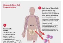 Apelacion urgente pa donante di stamcel