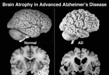 Fundacion Alzheimer Aruba ta organisa simposio y ta anuncia proyectonan den conexion cu nan 20 aña como fundacion