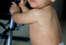 Agencia di salud Europeo ta adverti di plamamento di sarampi