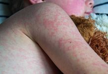 Mexico: Secretaria di salud ta emiti un alerta epidemiologico pa sarampi