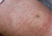 Señal y sintomanan di Measles (sarampi)