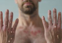 DVG ta duna conseho tocante prevencion di mpox