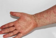 Grado di proteccion di grupo ta hopi halto, segun Wit Gele Kruis| Riesgo pa epidemia di sarampi na Aruba ta hopi abou