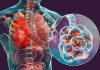 Un morto pa malesa di Legionnaires na New York