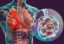 Un morto pa malesa di Legionnaires na New York