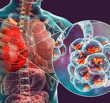 Un morto pa malesa di Legionnaires na New York